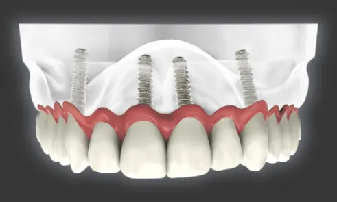 What are All-on-4 Implants?