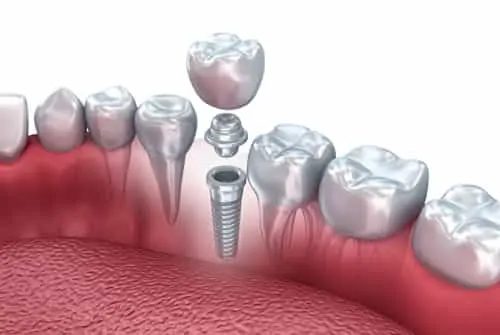 Dental Implants Arlington VA