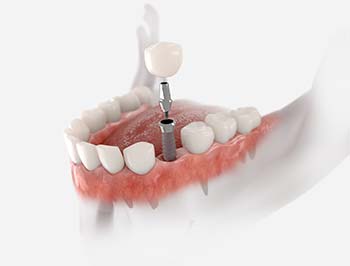 are dental implants painful