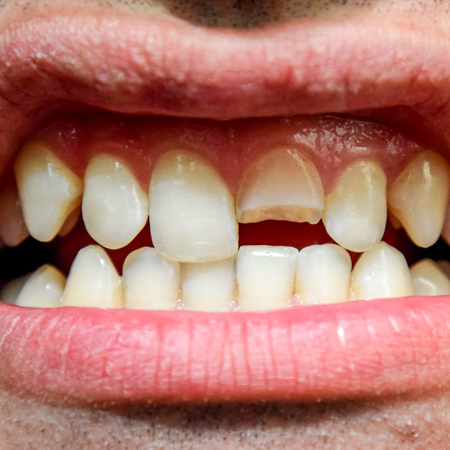 Fractured Tooth (Cracked Tooth) - Causes, Symptoms, Treatment, Prevention