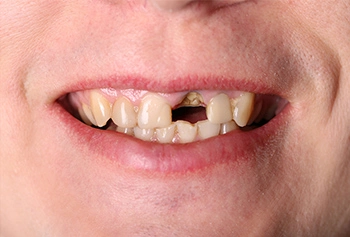 Loose Teeth - Causes, Treatment & Prevention