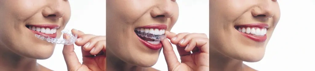 Can I chew gum with Invisalign?